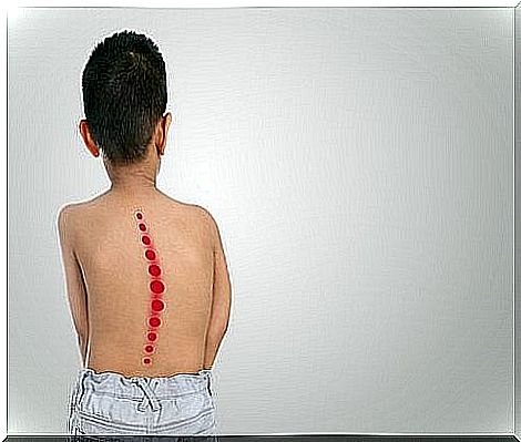 Children with scoliosis