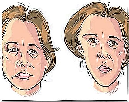 An illustration of a woman with facial paralysis.